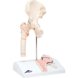 3B® Anatomical Model - Femoral Fracture and Hip Osteoarthritis 12-4577