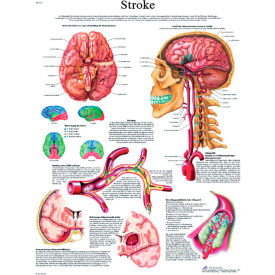 3B® Anatomical Chart - Stroke Chart Laminated 12-4629L