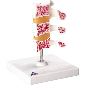 3B® Anatomical Model - Deluxe Osteoporosis (3 Vertebrae) 12-4807