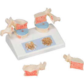 3B® Anatomical Model - Osteoporosis Model 12-4544