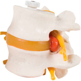 3B® Anatomical Model - 2 Lumbar Vertebrae with Prolapsed Disc Flexibly Mounted 12-4595